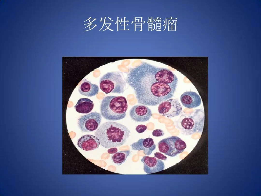 塞利尼索对多发性骨髓瘤有很显著的疗效 塞利尼索对多发性骨髓瘤有很显著的疗效