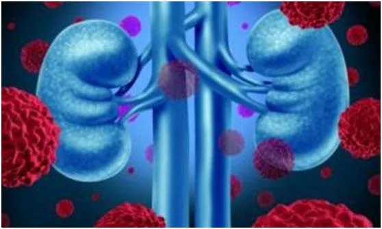 belzutifan + cabozantinib :点亮晚期肾透明细胞癌一线治疗曙光 belzutifan + cabozantinib :点亮晚期肾透明细胞癌一线治疗曙光