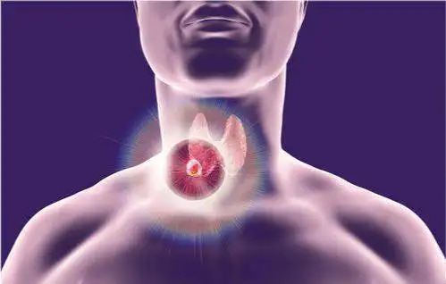 卡博替尼(cabozantinib) 与普拉替尼 (pralsetinib)治疗甲状腺癌对比效果如何? 卡博替尼(cabozantinib) 与普拉替尼 (pralsetinib)治疗甲状腺癌对比效果如何?
