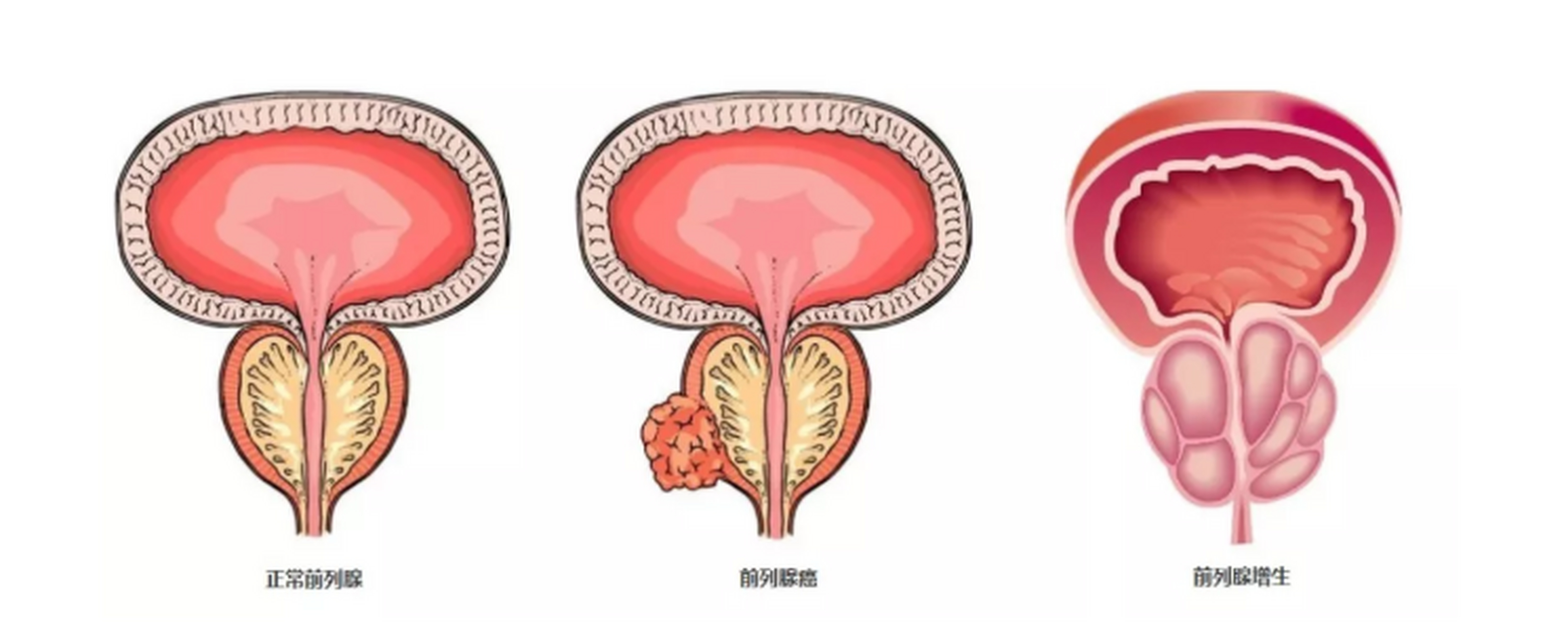 奥拉帕利(olaparib)治疗前列腺癌疗效如何? 奥拉帕利(olaparib)治疗前列腺癌疗效如何?