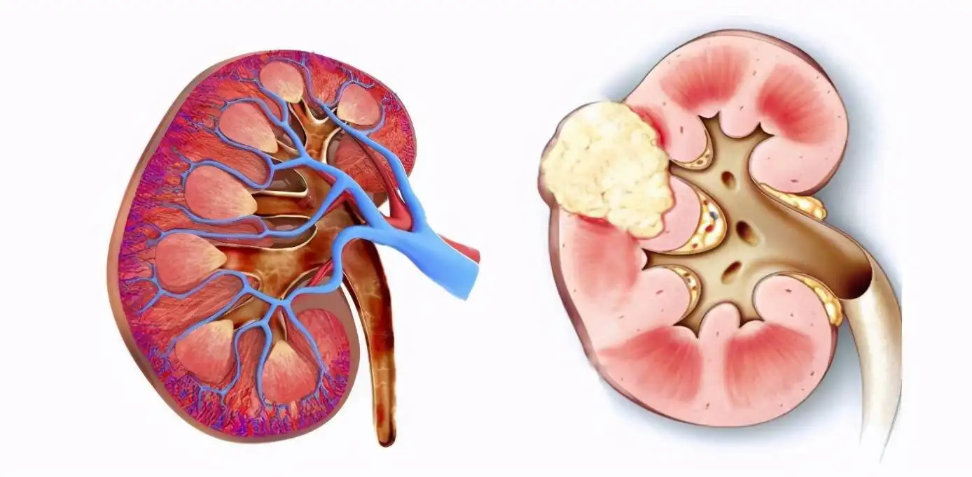 卡博替尼(cabozantinib)治疗晚期肾细胞癌疗效如何？