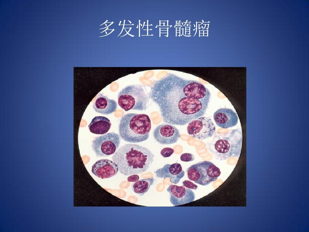 塞利尼索对多发性骨髓瘤有很显著的疗效 塞利尼索对多发性骨髓瘤有很显著的疗效