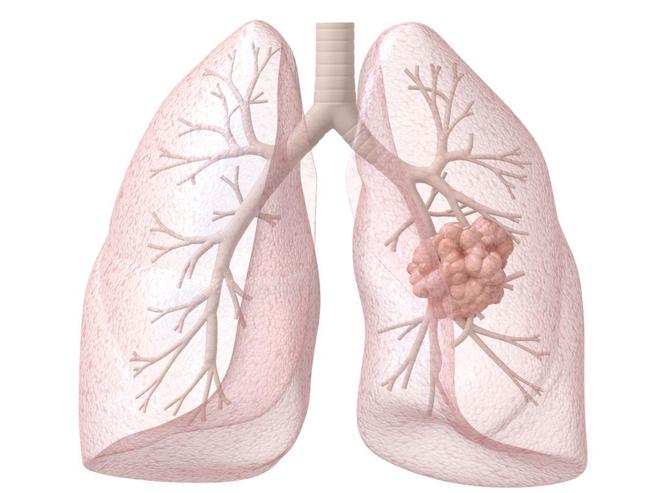 奥希替尼可以治疗肺癌吗?口服奥希替尼有副作用吗? 奥希替尼可以治疗肺癌吗?口服奥希替尼有副作用吗?