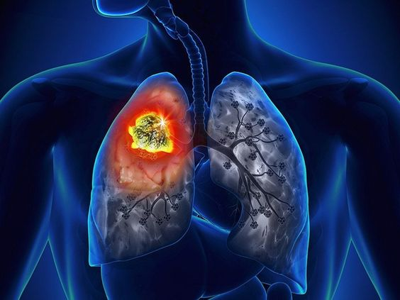【医康行】：肺癌常用化疗药物与其不良反应处理方法