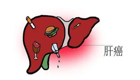 仑伐替尼与索拉非尼：用于肝癌的一线治疗？