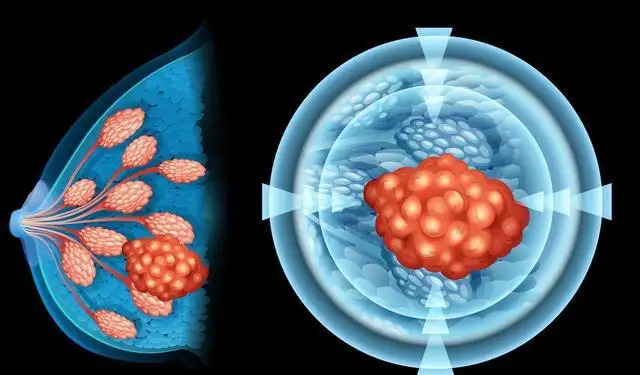 卡帕塞替尼(TRUQAP/CAPIVASERTIB)联合氟维司群对乳腺癌有效果？